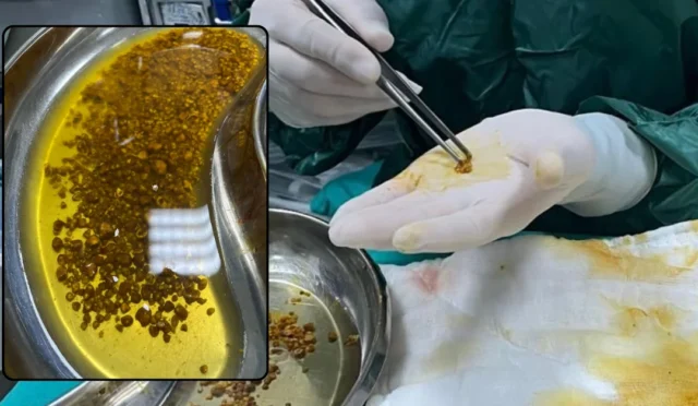 Safra kesesinden 2 bin 67 taş çıkan hasta ameliyat edildi