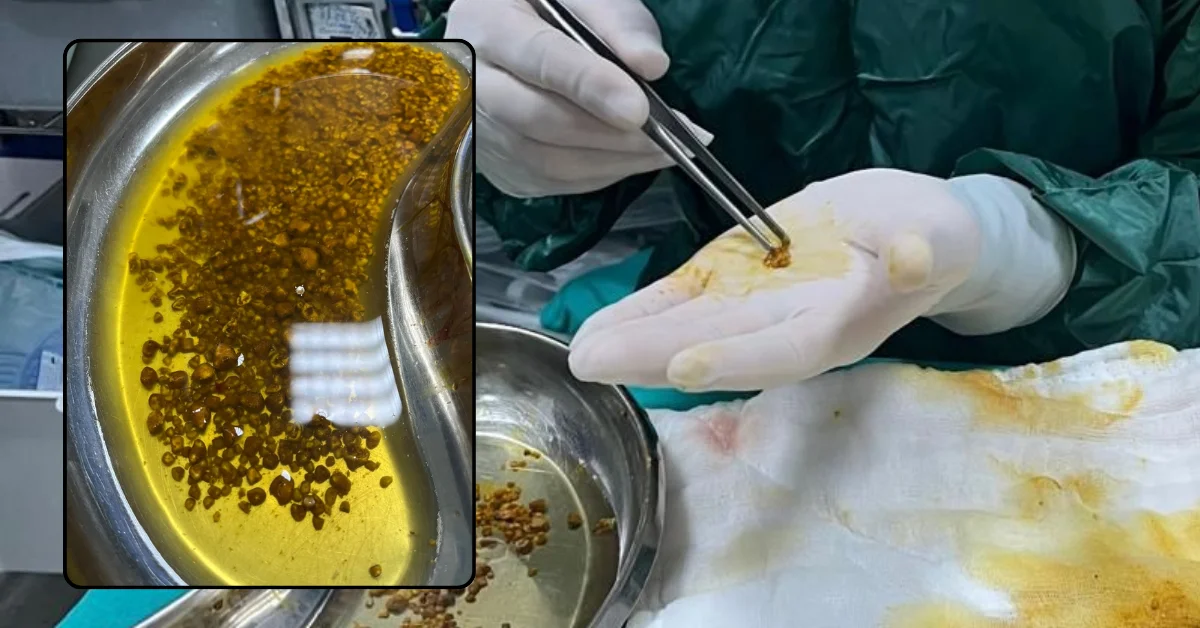 Doktorları Bile Şaşkına Çeviren Vaka: Safra Kesesinden 2 Bin 67 Taş Çıkarıldı